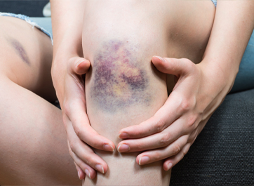 Contusion